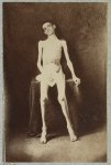 [Emaciated prisoner of war from Belle Isle, Richmond, Private William M. Smith of Co. D of 8th Kentucky Volunteers, at the U.S. General Hospital, Div. 1, Annapolis]