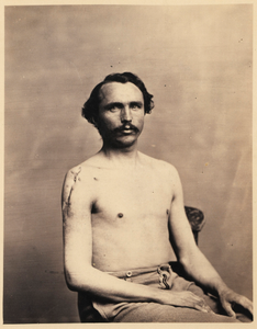 Private Adolph Zirsse, Successful Intermediate Excision of the Head and two and a half inches of the Shaft of the Right Humerus, from the Photographic Catalogue of the Surgical Section