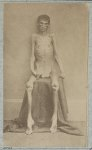 [Unidentified emaciated prisoner of war, from Belle Isle, Richmond, at the U.S. General Hospital, Div. 1, Annapolis]